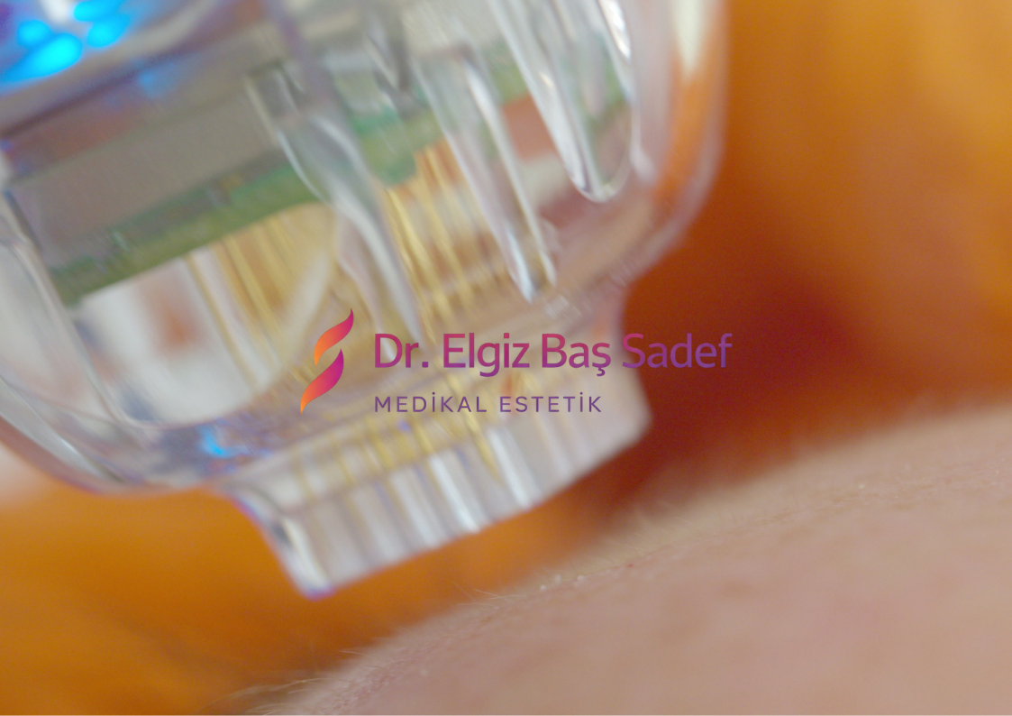 Altın İğne (Fractional RF)