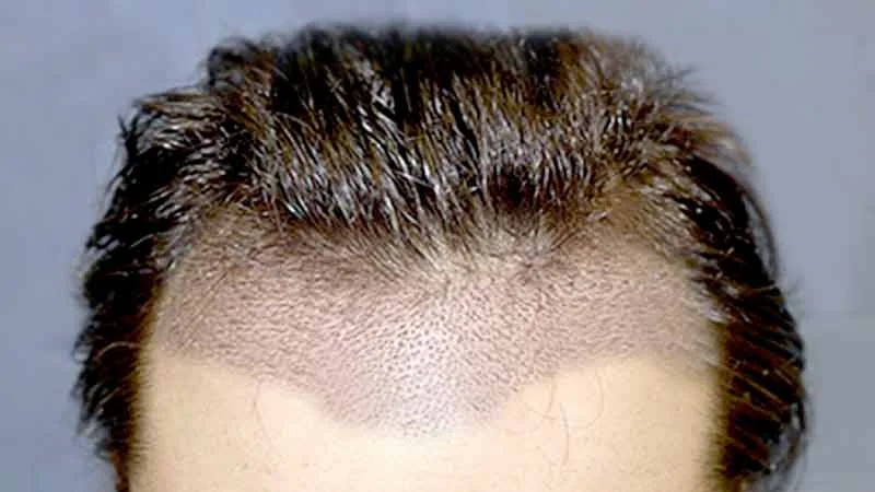 TIRAŞSIZ SAÇ EKİMİ